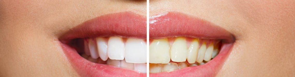 albire-dentara-evolution-dent