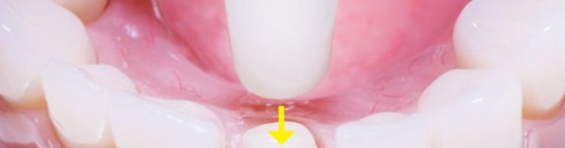 coroana-integral-ceramica-dinte-ceramica